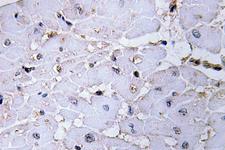LBC / AKAP13 Antibody - IHC of AKAP 13 (D738) pAb in paraffin-embedded human lung carcinoma tissue.