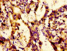 LBP Antibody - Immunohistochemistry image of paraffin-embedded human gastric cancer at a dilution of 1:100