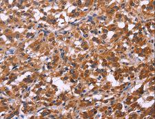 LCA3 / SPATA7 Antibody - Immunohistochemistry of paraffin-embedded Human cervical cancer using SPATA7 Polyclonal Antibody at dilution of 1:30.