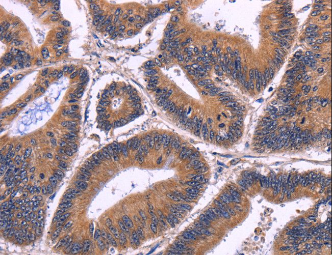 LCA3 / SPATA7 Antibody - Immunohistochemistry of paraffin-embedded Human cervical cancer using SPATA7 Polyclonal Antibody at dilution of 1:30.