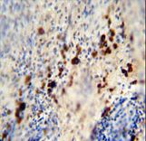 LCE1A Antibody - LCE1A antibody immunohistochemistry of formalin-fixed and paraffin-embedded human skin carcinoma followed by peroxidase-conjugated secondary antibody and DAB staining.