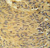LCLAT1 Antibody - LCLT1 Antibody immunohistochemistry of formalin-fixed and paraffin-embedded human lung carcinoma followed by peroxidase-conjugated secondary antibody and DAB staining.