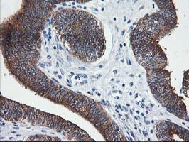 LCMT1 Antibody - IHC of paraffin-embedded Adenocarcinoma of Human endometrium tissue using anti-LCMT1 mouse monoclonal antibody.