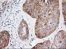 LCMT1 Antibody - IHC of paraffin-embedded Adenocarcinoma of Human breast tissue using anti-LCMT1 mouse monoclonal antibody.