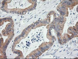 LCMT1 Antibody - IHC of paraffin-embedded Adenocarcinoma of Human colon tissue using anti-LCMT1 mouse monoclonal antibody.