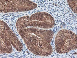 LCMT1 Antibody - IHC of paraffin-embedded Adenocarcinoma of Human endometrium tissue using anti-LCMT1 mouse monoclonal antibody.