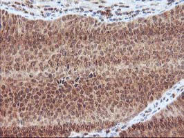 LCMT1 Antibody - IHC of paraffin-embedded Carcinoma of Human bladder tissue using anti-LCMT1 mouse monoclonal antibody.