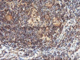 LCMT1 Antibody - IHC of paraffin-embedded Human lymphoma tissue using anti-LCMT1 mouse monoclonal antibody.