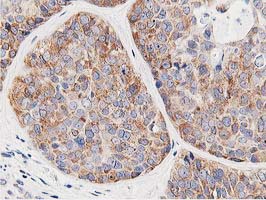 LCMT1 Antibody - IHC of paraffin-embedded Adenocarcinoma of Human breast tissue using anti-LCMT1 mouse monoclonal antibody.