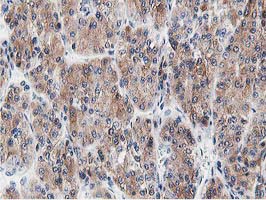 LCMT1 Antibody - IHC of paraffin-embedded Carcinoma of Human liver tissue using anti-LCMT1 mouse monoclonal antibody.