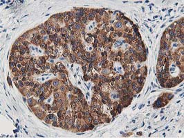 LCMT1 Antibody - IHC of paraffin-embedded Carcinoma of Human pancreas tissue using anti-LCMT1 mouse monoclonal antibody.