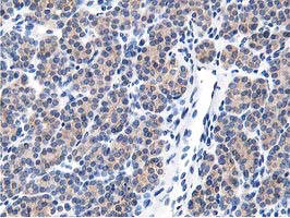 LCMT1 Antibody - IHC of paraffin-embedded Carcinoma of Human thyroid tissue using anti-LCMT1 mouse monoclonal antibody.
