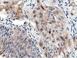 LCMT1 Antibody - IHC of paraffin-embedded Carcinoma of Human bladder tissue using anti-LCMT1 mouse monoclonal antibody.