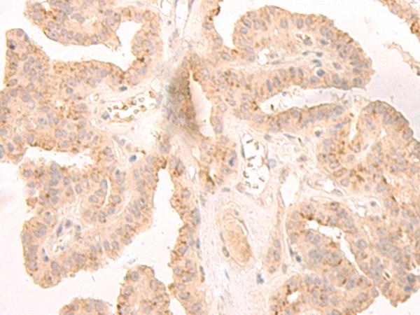 LCMT2 / YW4 Antibody - Immunohistochemistry of paraffin-embedded Human thyroid cancer tissue  using LCMT2 Polyclonal Antibody at dilution of 1:45(×200)