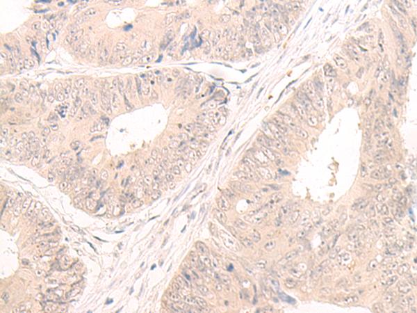 LCMT2 / YW4 Antibody - Immunohistochemistry of paraffin-embedded Human colorectal cancer tissue  using LCMT2 Polyclonal Antibody at dilution of 1:55(×200)
