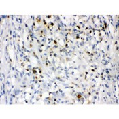LCN2 / Lipocalin 2 / NGAL Antibody - Lipocalin 2 antibody IHC-paraffin. IHC(P): Human Intestinal Cancer Tissue.