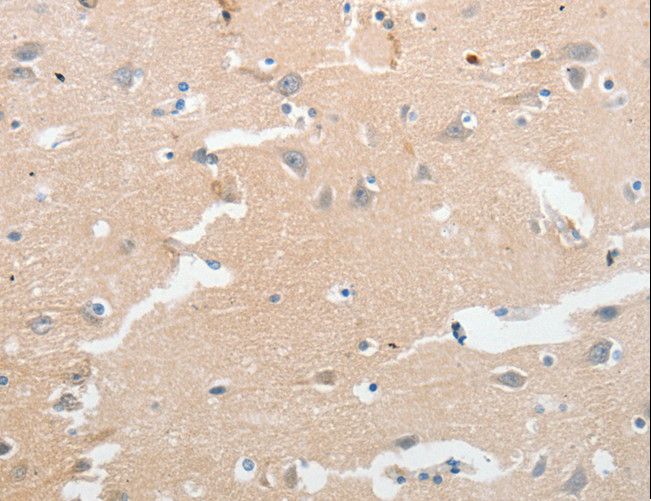 LCN2 / Lipocalin 2 / NGAL Antibody - Immunohistochemistry of paraffin-embedded Human liver cancer using LCN2 Polyclonal Antibody at dilution of 1:50.