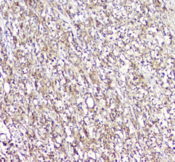 LCP1 / L-Plastin Antibody - IHC staining of FFPE human lymphocytic tumor with L Plastin antibody at 1ug/ml. HIER: boil tissue sections in pH6, 10mM citrate buffer, for 10-20 min and allow to cool before testing.