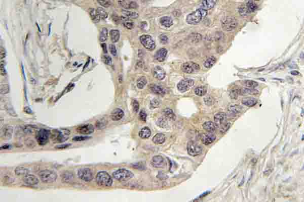 LCP2 / SLP-76 Antibody - IHC of SLP-76 (G122) pAb in paraffin-embedded human breast carcinoma tissue.