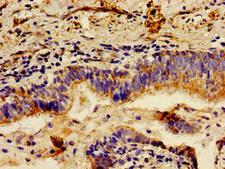 LCT / Lactase Antibody - Immunohistochemistry image of paraffin-embedded human lung cancer at a dilution of 1:100