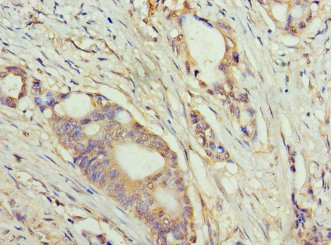 LCX / TET1 Antibody - Paraffin-embedding Immunohistochemistry using human colon cancer at dilution 1:100