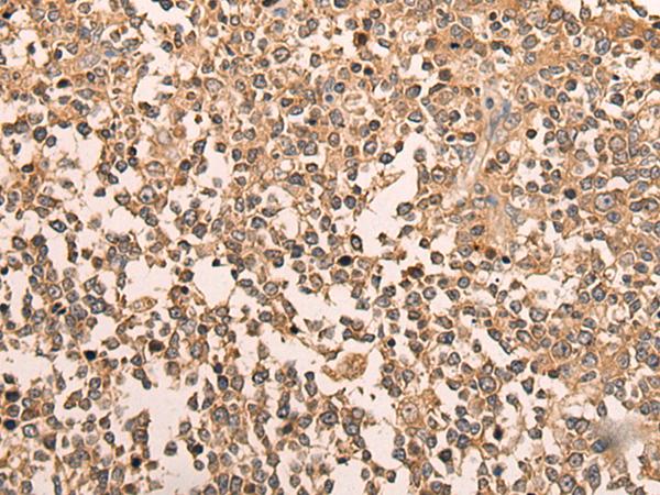 LDAH Antibody - Immunohistochemistry of paraffin-embedded Human tonsil tissue  using LDAH Polyclonal Antibody at dilution of 1:70(×200)