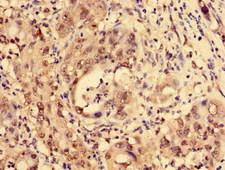 LDB1 / CLIM2 Antibody - Immunohistochemistry image of paraffin-embedded human liver cancer at a dilution of 1:100