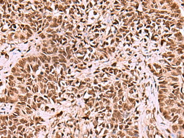 LDB1 / CLIM2 Antibody - Immunohistochemistry of paraffin-embedded Human ovarian cancer tissue  using LDB1 Polyclonal Antibody at dilution of 1:70(×200)