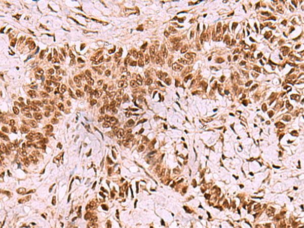 LDB1 / CLIM2 Antibody - Immunohistochemistry of paraffin-embedded Human ovarian cancer tissue  using LDB1 Polyclonal Antibody at dilution of 1:70(×200)