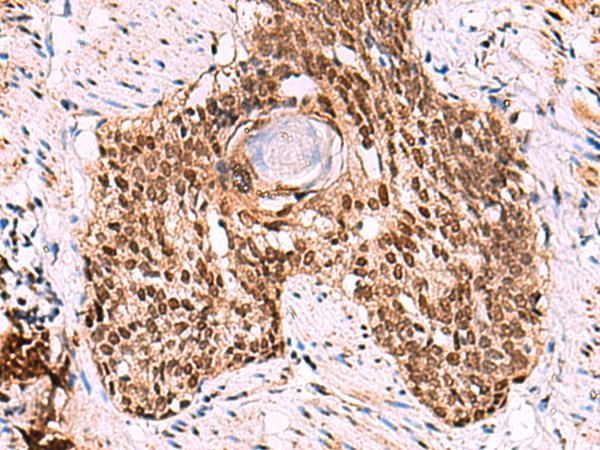 LDB1 / CLIM2 Antibody - Immunohistochemistry of paraffin-embedded Human esophagus cancer tissue  using LDB1 Polyclonal Antibody at dilution of 1:70(×200)