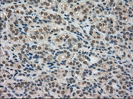 LDHA / LDH1 Antibody - Immunohistochemical staining of paraffin-embedded Carcinoma of thyroid tissue using anti-LDHA mouse monoclonal antibody. (Dilution 1:50).
