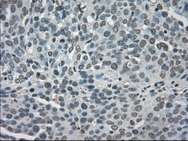 LDHA / LDH1 Antibody - IHC of paraffin-embedded Adenocarcinoma of ovary tissue using anti-LDHA mouse monoclonal antibody. (Dilution 1:50).