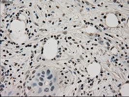 LDHA / LDH1 Antibody - IHC of paraffin-embedded Carcinoma of pancreas tissue using anti-LDHA mouse monoclonal antibody. (Dilution 1:50).