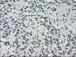 LDHA / LDH1 Antibody - IHC of paraffin-embedded Carcinoma of bladder tissue using anti-LDHA mouse monoclonal antibody. (Dilution 1:50).