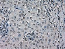 LDHA / LDH1 Antibody - IHC of paraffin-embedded Adenocarcinoma of breast tissue using anti-LDHA mouse monoclonal antibody. (Dilution 1:50).