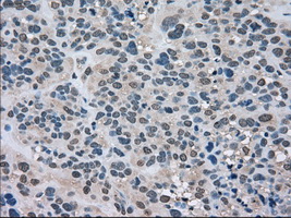 LDHA / LDH1 Antibody - Immunohistochemical staining of paraffin-embedded Carcinoma of bladder tissue using anti-LDHA mouse monoclonal antibody. (Dilution 1:50).