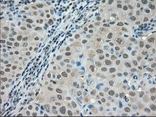 LDHA / LDH1 Antibody - Immunohistochemical staining of paraffin-embedded Adenocarcinoma of breast tissue using anti-LDHA mouse monoclonal antibody. (Dilution 1:50).