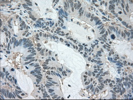 LDHA / LDH1 Antibody - Immunohistochemical staining of paraffin-embedded Adenocarcinoma of colon tissue using anti-LDHA mouse monoclonal antibody. (Dilution 1:50).