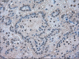 LDHA / LDH1 Antibody - Immunohistochemical staining of paraffin-embedded Carcinoma of kidney tissue using anti-LDHA mouse monoclonal antibody. (Dilution 1:50).
