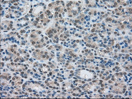 LDHA / LDH1 Antibody - Immunohistochemical staining of paraffin-embedded Carcinoma of thyroid tissue using anti-LDHA mouse monoclonal antibody. (Dilution 1:50).