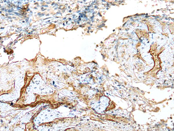 LDHD / Lactate Dehydrogenase D Antibody - Immunohistochemistry of paraffin-embedded Human cervical cancer tissue  using LDHD Polyclonal Antibody at dilution of 1:120(×200)