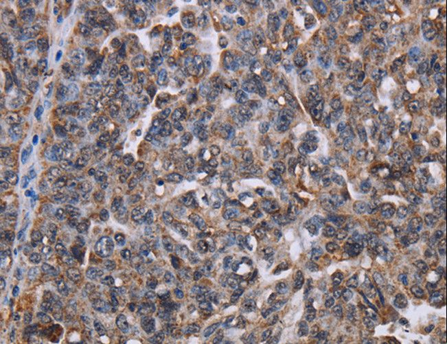 LDOC1 Antibody - Immunohistochemistry of paraffin-embedded Human ovarian cancer using LDOC1 Polyclonal Antibody at dilution of 1:50.