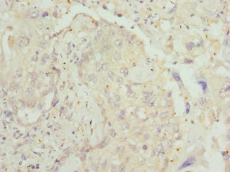 LECT1 / Chondromodulin-I Antibody - Immunohistochemistry of paraffin-embedded human lung cancer at dilution 1:100