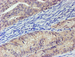 LECT2 Antibody - IHC of paraffin-embedded Adenocarcinoma of Human endometrium tissue using anti-LECT2 mouse monoclonal antibody.