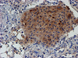 LECT2 Antibody - IHC of paraffin-embedded Carcinoma of Human lung tissue using anti-LECT2 mouse monoclonal antibody.
