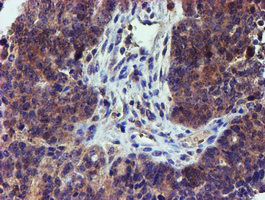 LECT2 Antibody - IHC of paraffin-embedded Adenocarcinoma of Human ovary tissue using anti-LECT2 mouse monoclonal antibody.