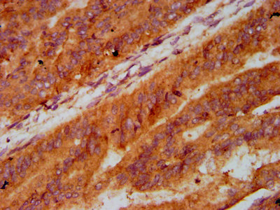 LECT2 Antibody - Immunohistochemistry Dilution at 1:400 and staining in paraffin-embedded human endometrial cancer performed on a Leica BondTM system. After dewaxing and hydration, antigen retrieval was mediated by high pressure in a citrate buffer (pH 6.0). Section was blocked with 10% normal Goat serum 30min at RT. Then primary antibody (1% BSA) was incubated at 4°C overnight. The primary is detected by a biotinylated Secondary antibody and visualized using an HRP conjugated SP system.