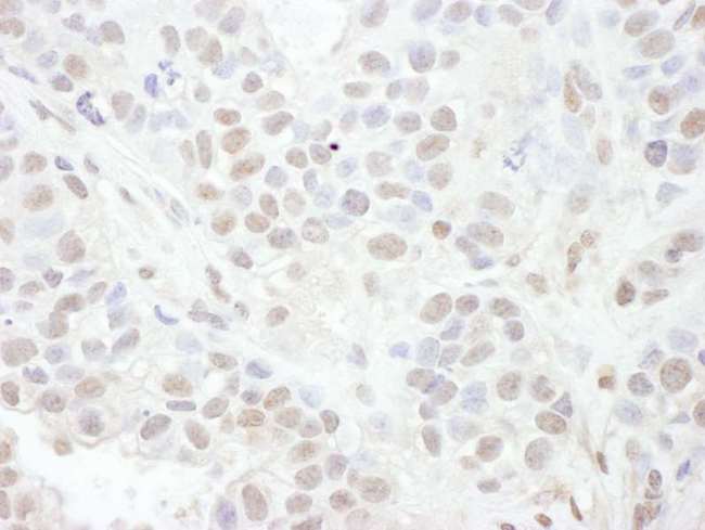 LEF1 Antibody - Detection of Human LEF1 by Immunohistochemistry. Sample: FFPE section of human breast carcinoma. Antibody: Affinity purified rabbit anti-LEF1 used at a dilution of 1:1000 (1 ug/ml). Detection: DAB.