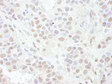 LEF1 Antibody - Detection of Human LEF1 by Immunohistochemistry. Sample: FFPE section of human breast carcinoma. Antibody: Affinity purified rabbit anti-LEF1 used at a dilution of 1:1000 (1 ug/ml). Detection: DAB.