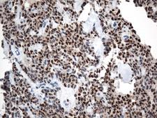LEF1 Antibody - Immunohistochemical staining of paraffin-embedded Carcinoma of Human pancreas tissue using anti-LEF1 mouse monoclonal antibody. (Heat-induced epitope retrieval by 1mM EDTA in 10mM Tris buffer. (pH8.5) at 120°C for 3 min. (1:500)